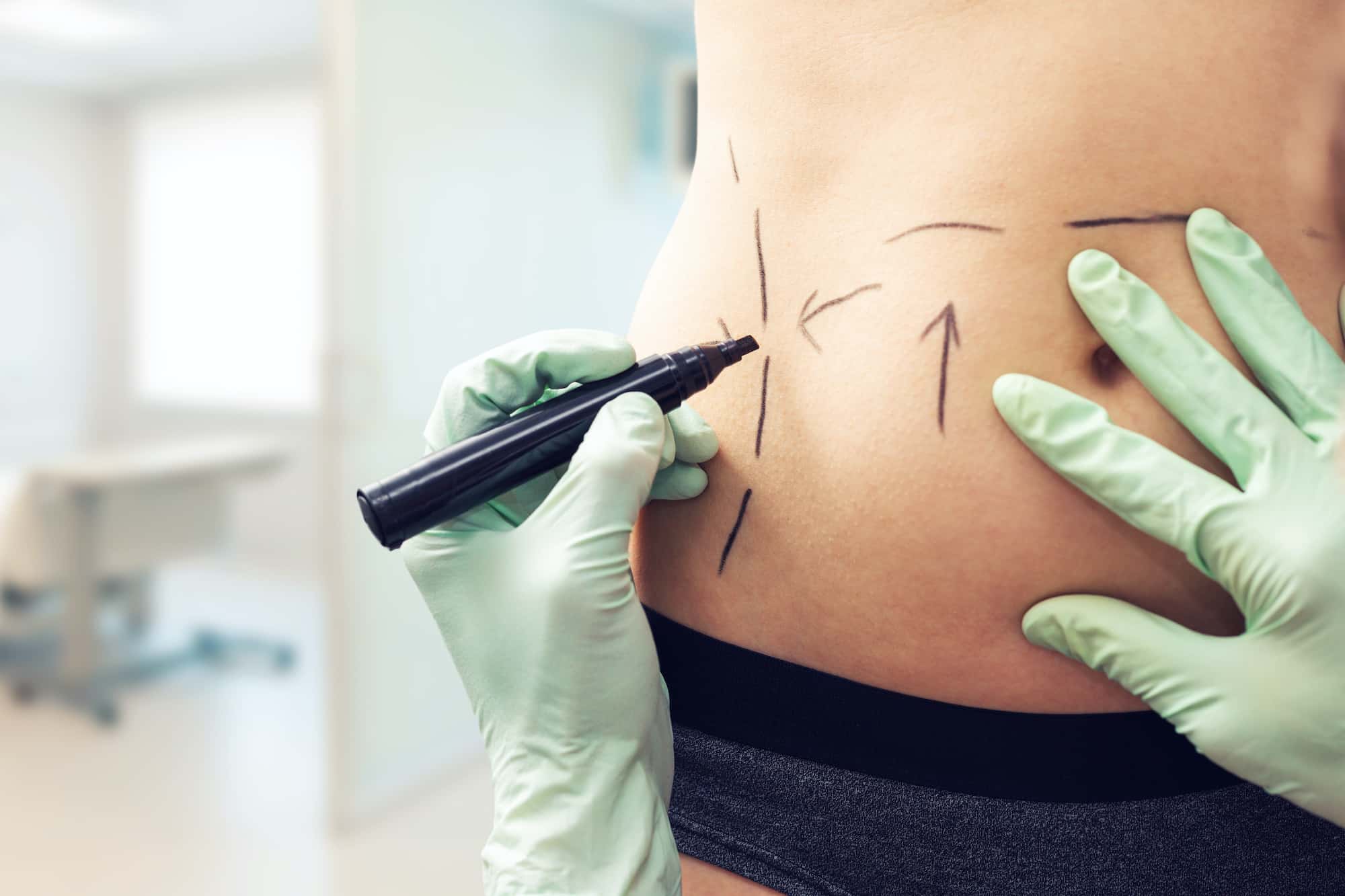 botched plastic surgery lawsuit