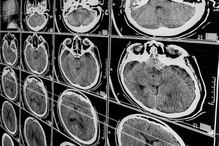 Coup-Contrecoup Brain Injuries