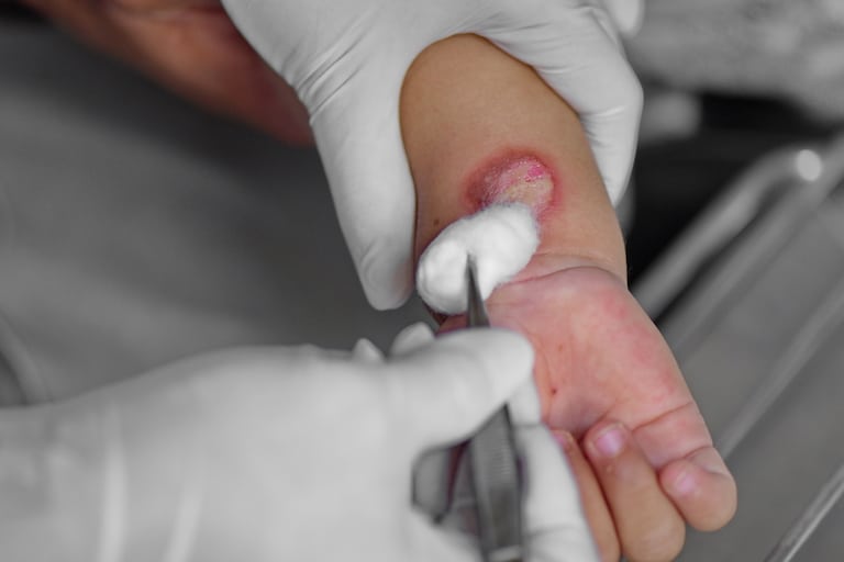Childhood Burn Injuries
