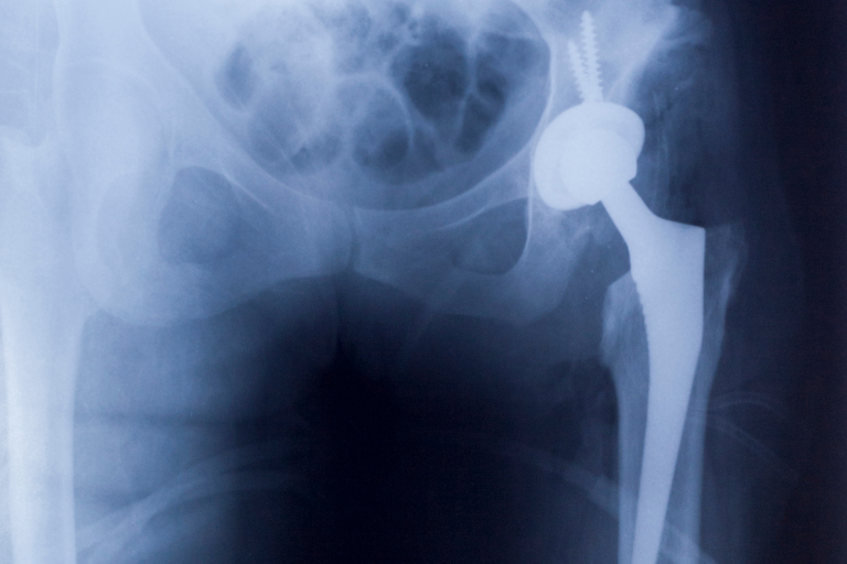 Injuries from Defective Medical Devices