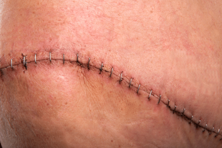 Incision with metal staples